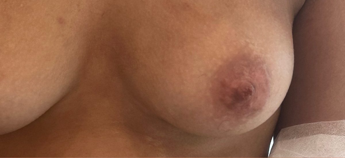 Aréole avec vitiligo après deux séances de camouflage par dermopigmentation : les zones claires contrastent moins avec la peau autour.