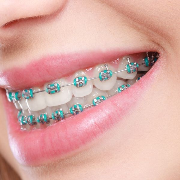 Prim-plan: aparat dentar cu brackets metalici