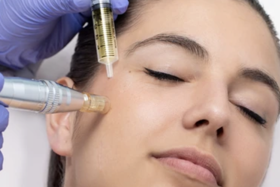 Immagine originale della dimostrazione di microneedling