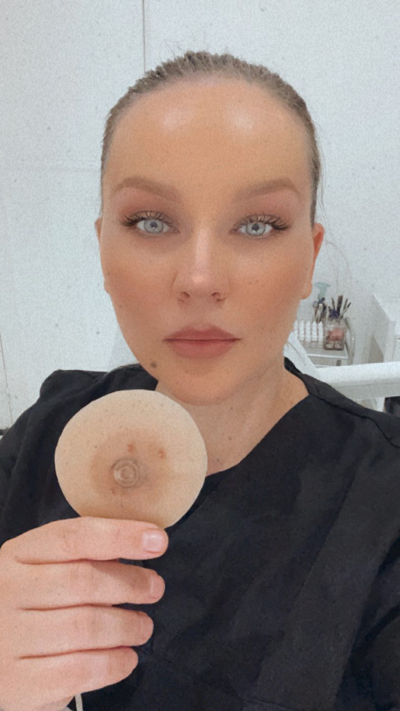 Yulia Valkovich présentant une aréole silicone de référence — reconstruction couleur après mastectomie