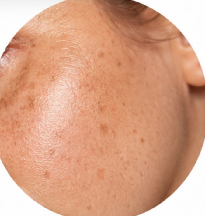 Sun damage treatment