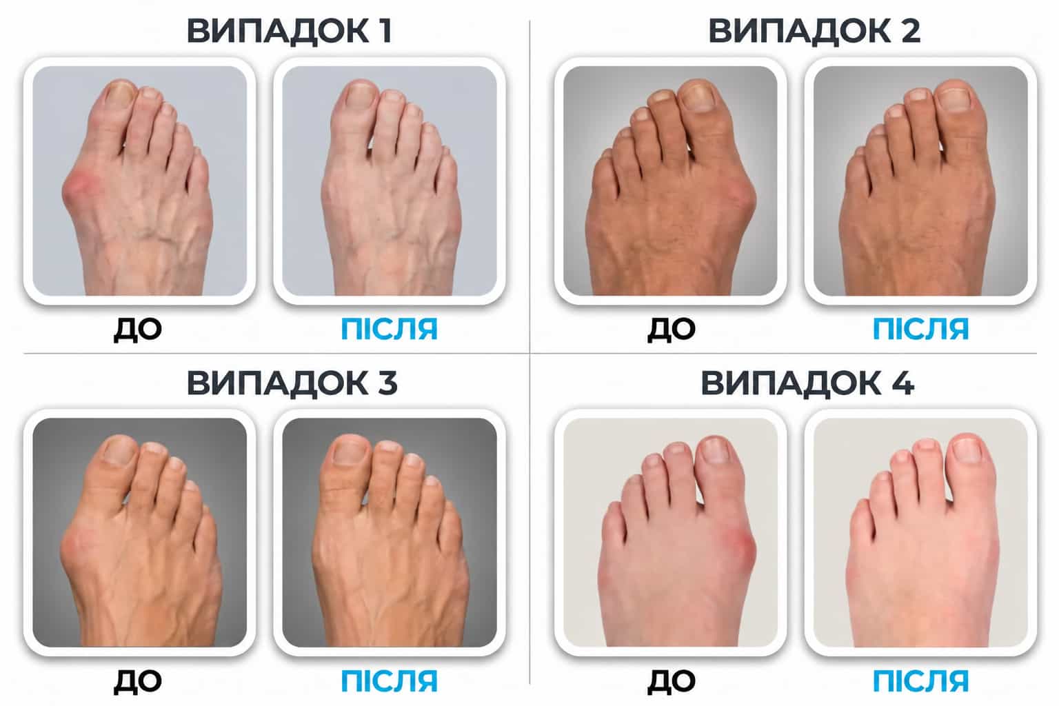 Регульована шина для великого пальця стопи