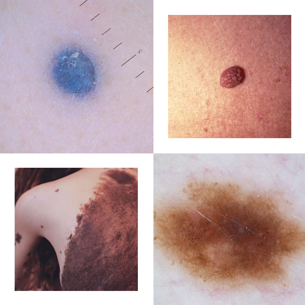 The main types of moles