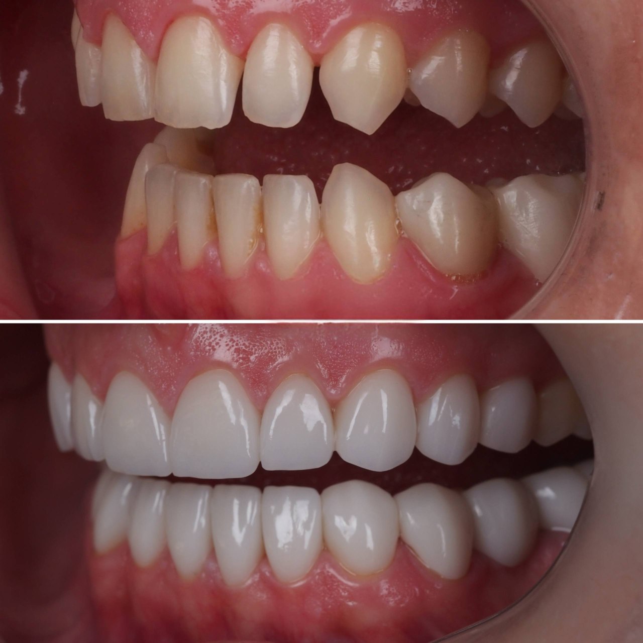 Professional dental implant treatment