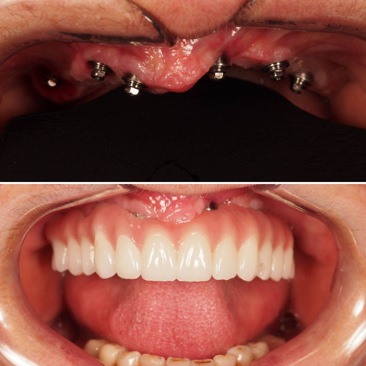 Dental implant procedure close up teeth