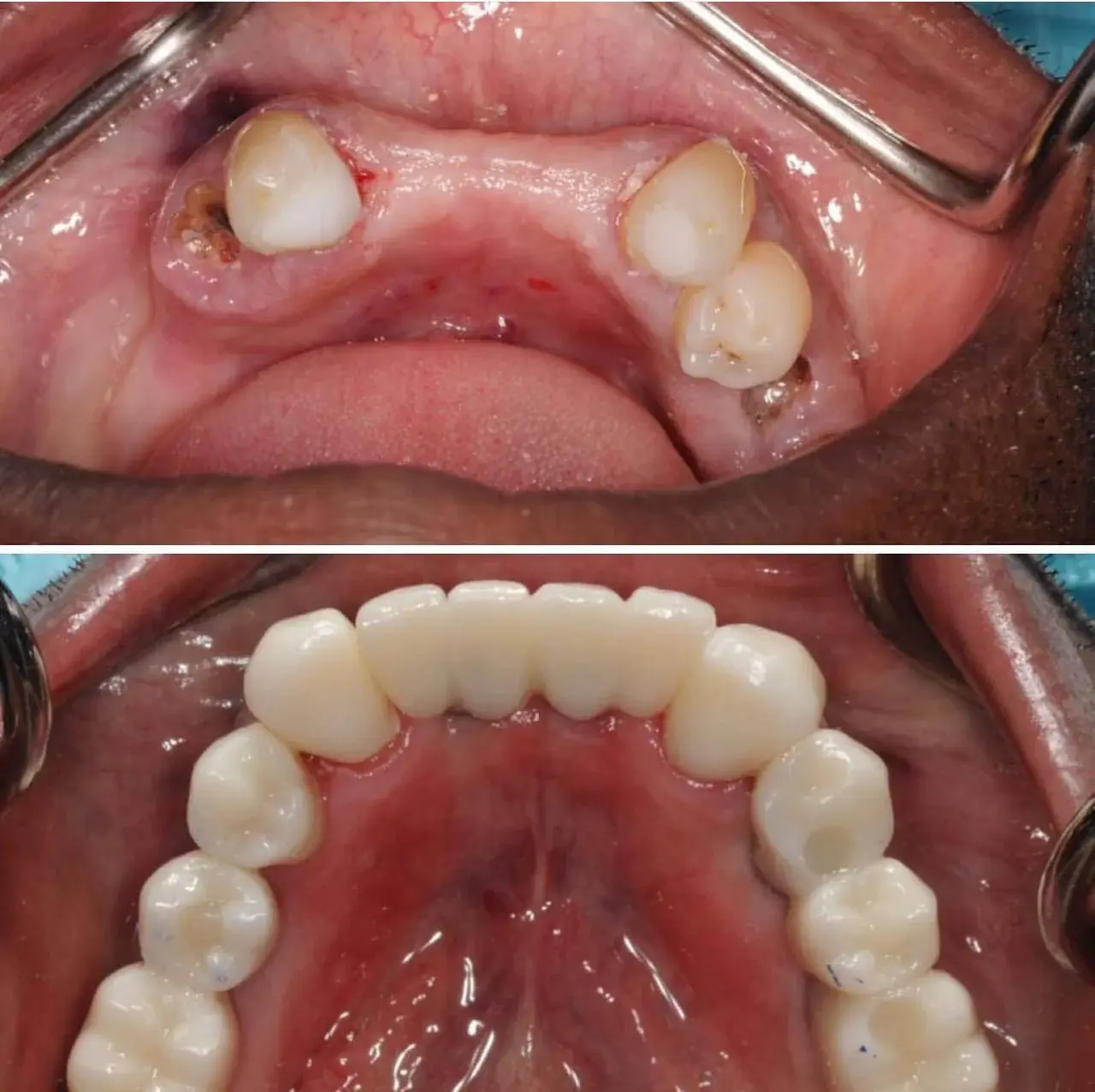 Professional dental implant treatment