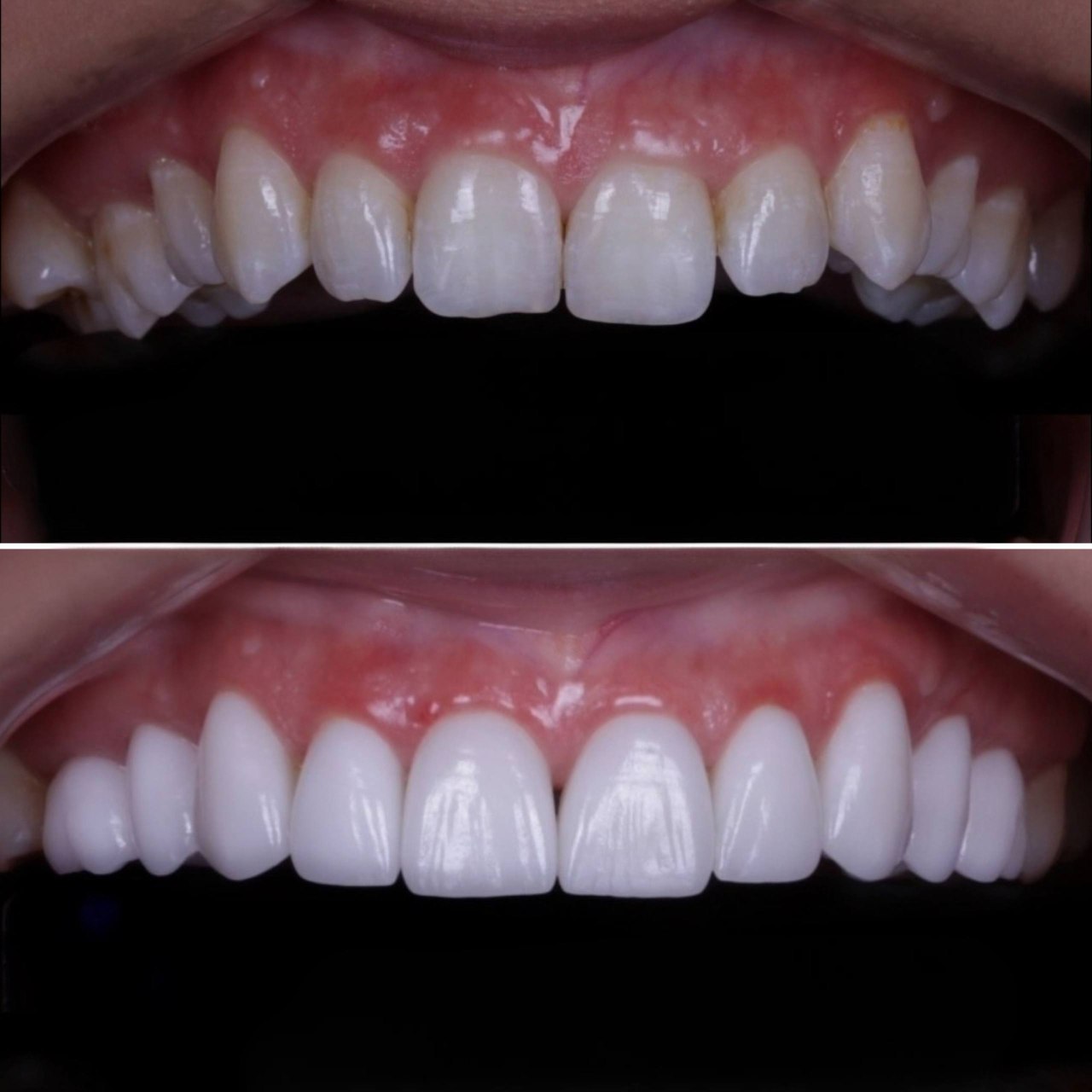 Dental implant smile restoration