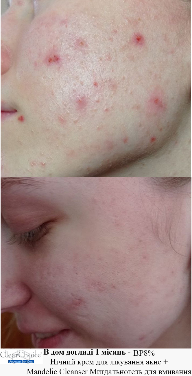Кейс ClearChoice: шкіра до та після місяця домашнього догляду з BP8% і Mandelic Cleanser