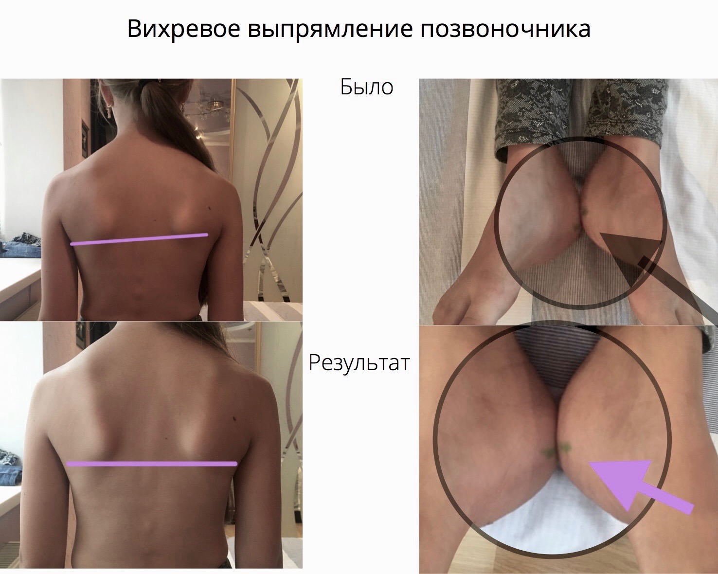 Вихревое выпрямление позвоночника, результат