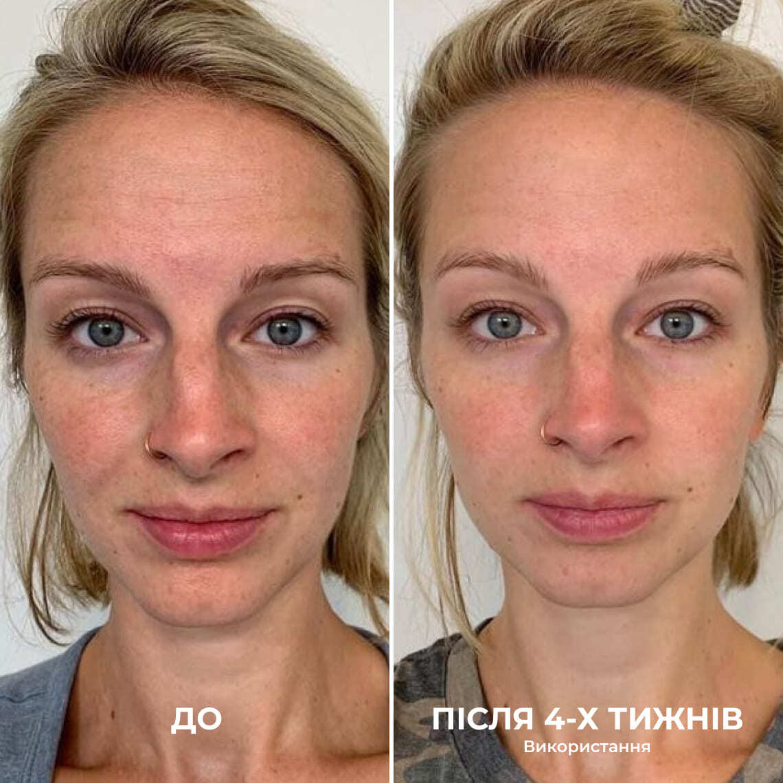 До і після 4 тижнів застосування — шия та підборіддя, фото 1