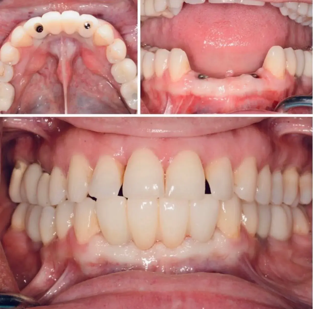 Dental implant smile restoration