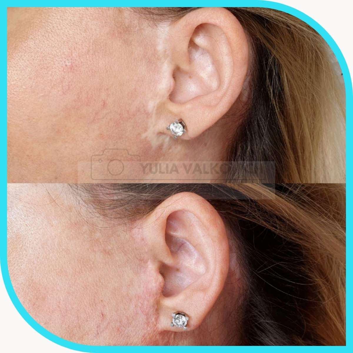 Cicatrice pré-auriculaire après lifting, avant (en haut) et après (en bas) dermopigmentation