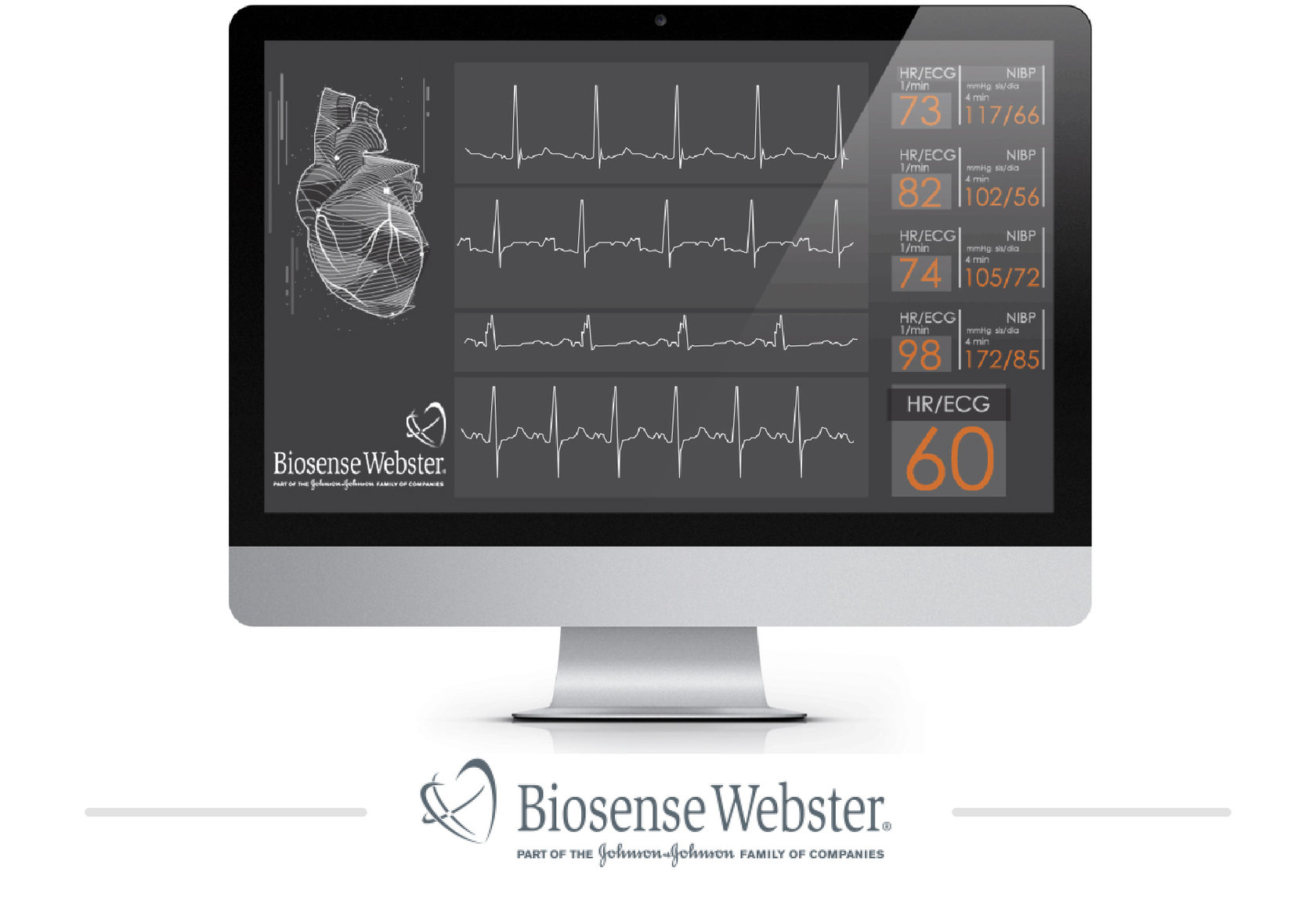 ECG analysis interface on a monitor
