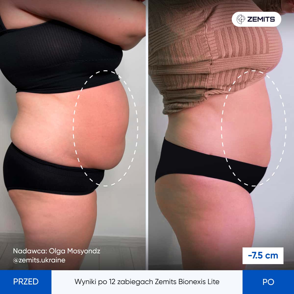 Wyniki po 12 zabiegach Zemits Bionexis Lite