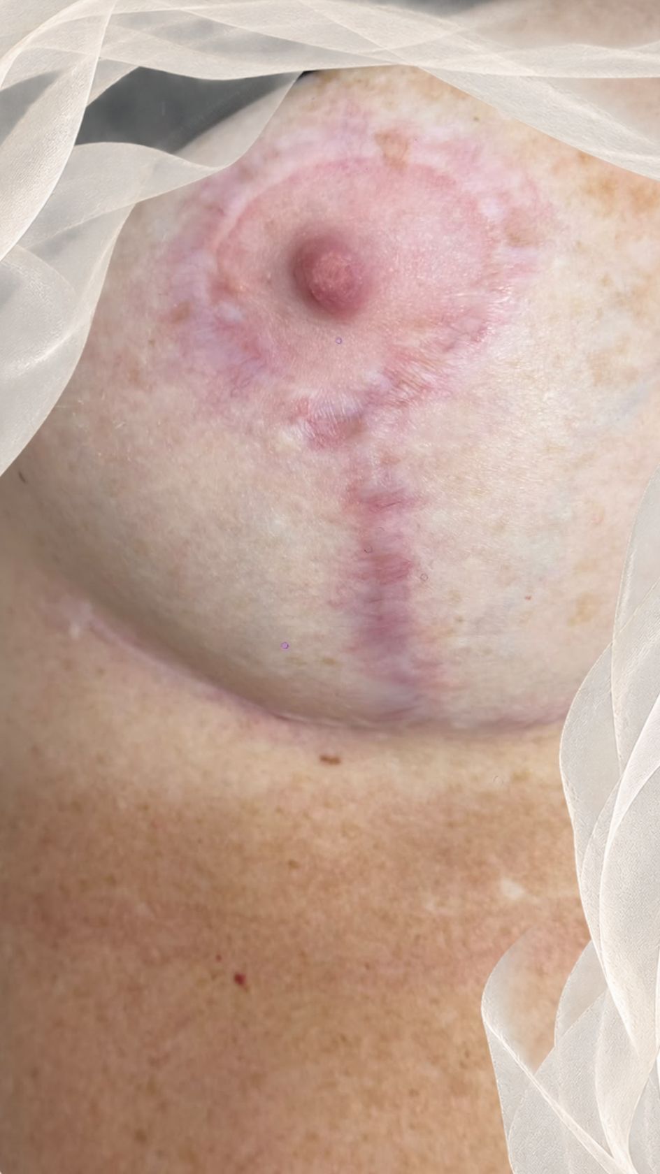 Cicatrice péri-aréolaire et verticale rosée sur le sein droit, après chirurgie mammaire