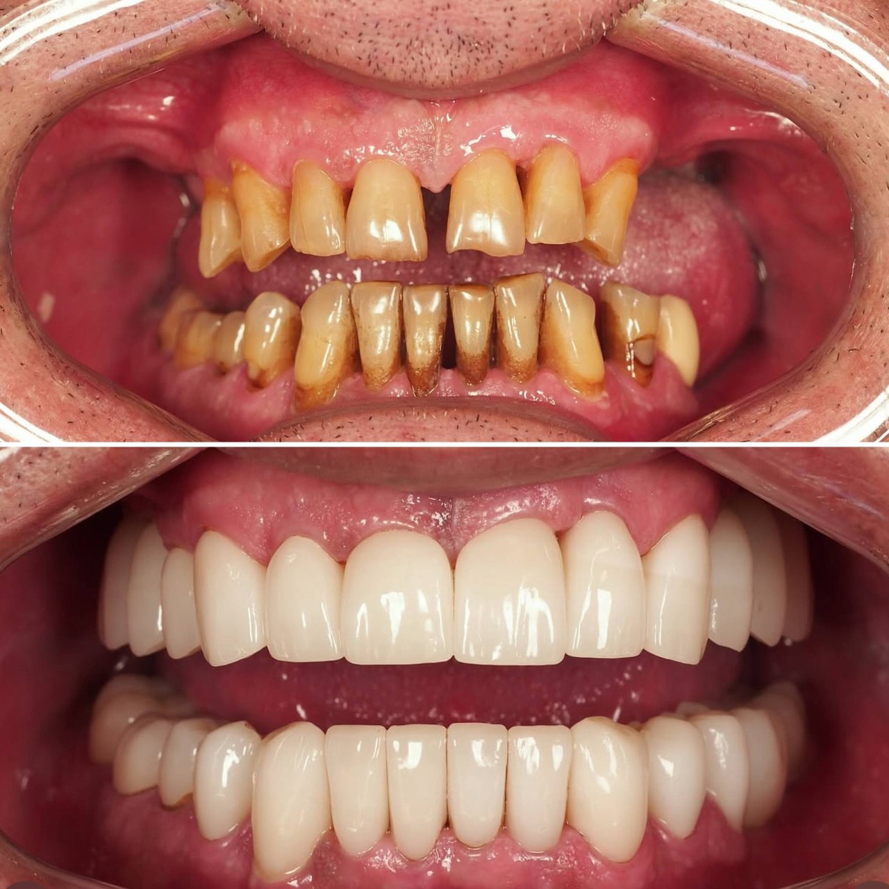 Dental bridge implant professional photo