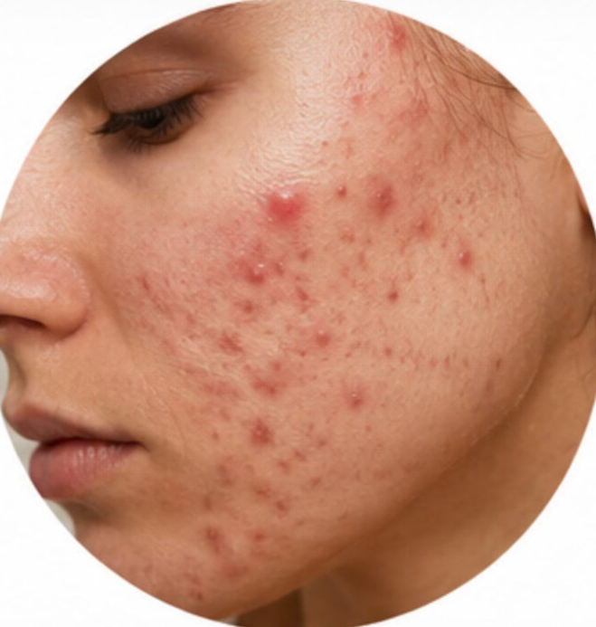 Acne facial