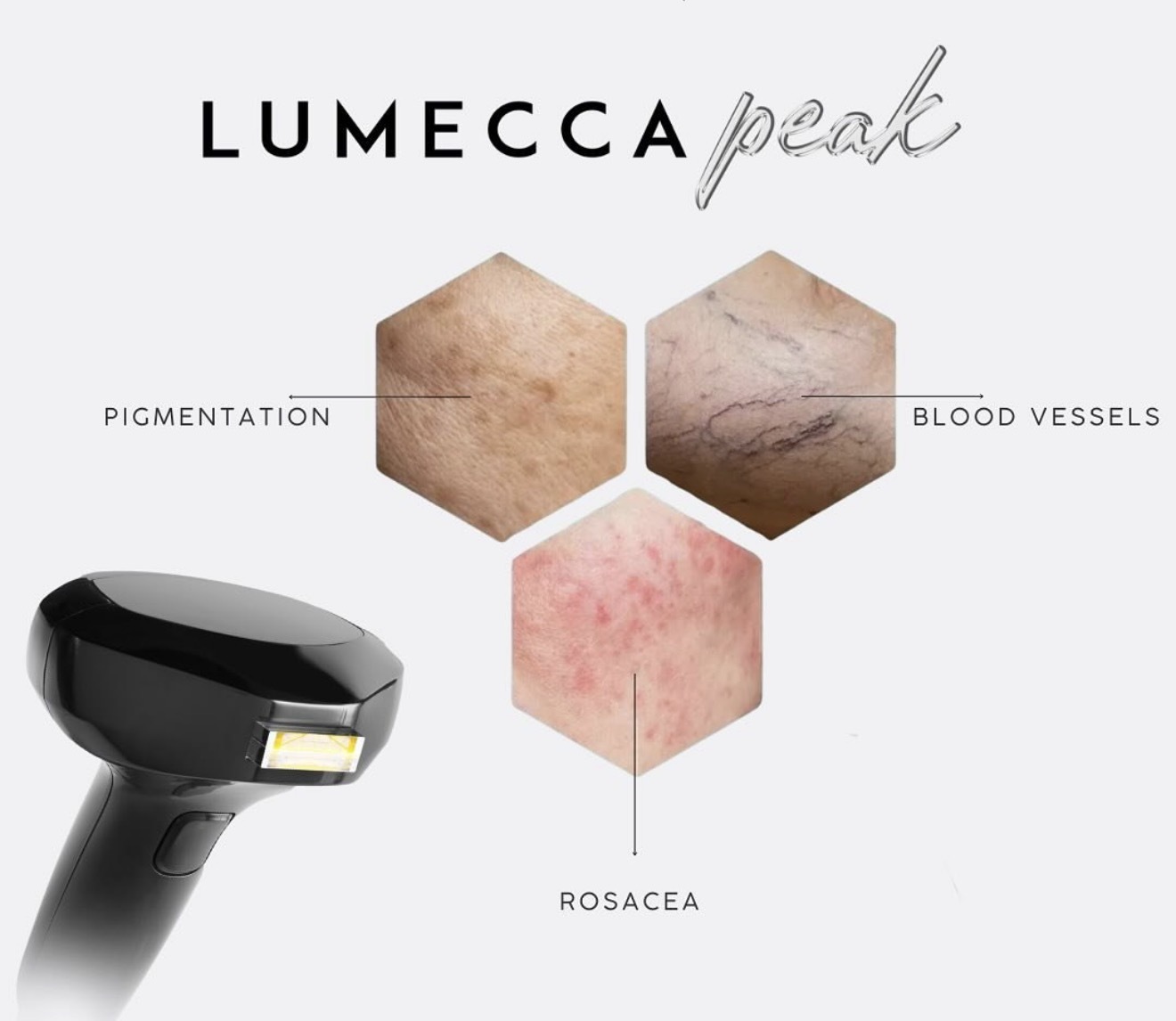 Ілюстрація Lumecca PEAK: пігментація, судинні прояви та розацеа