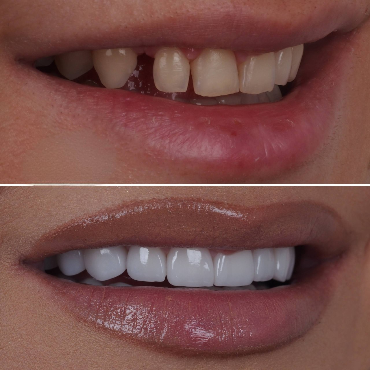 Dental implant before after smile