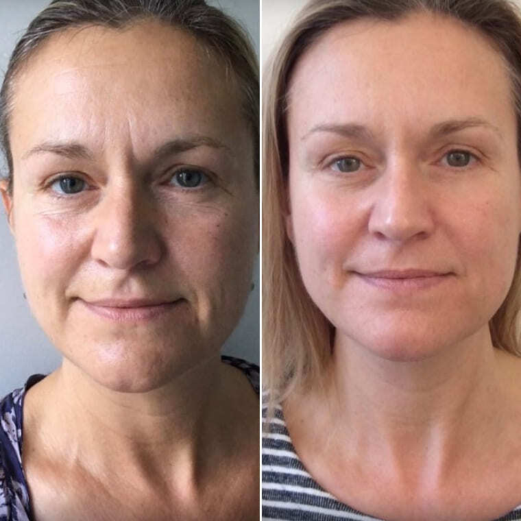 Обличчя до та після — Оксана Д., 52 роки