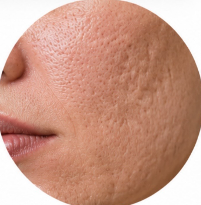 Skin texture treatment