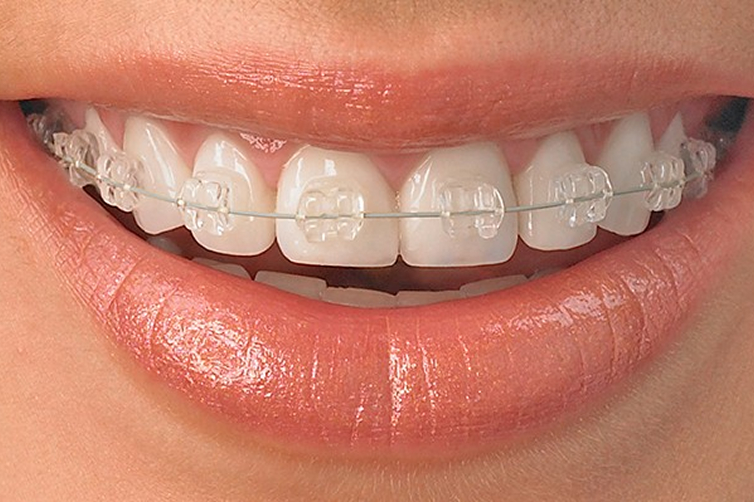 Prim-plan: aparat dentar cu brackets din safir