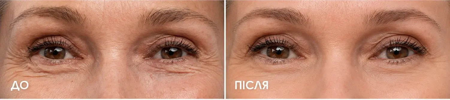 Фото до та після застосування BEAUTIFEYE®