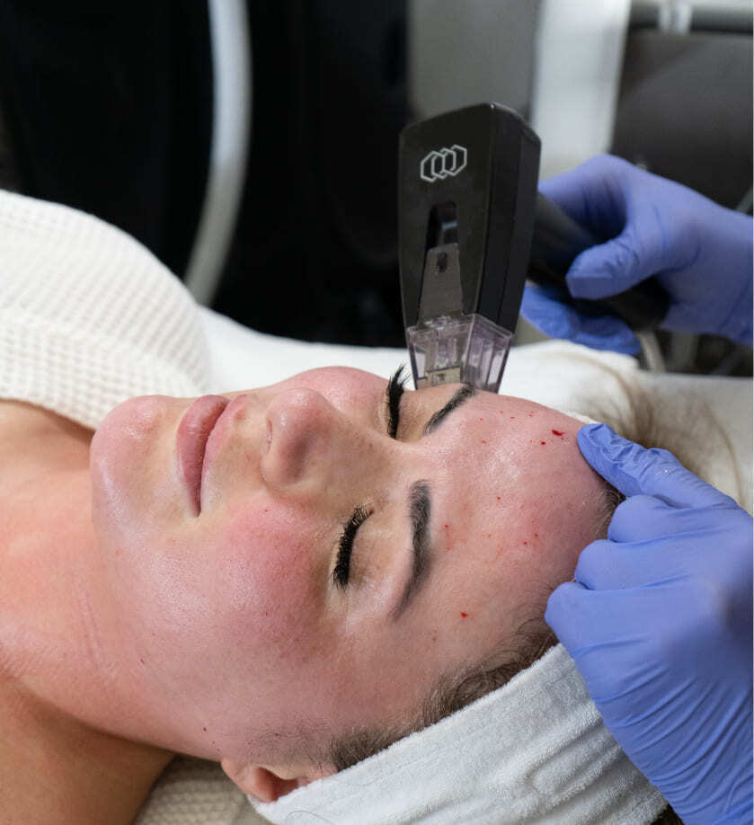 Morpheus8 Behandlung