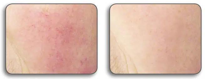 Kuperóza — pred a po