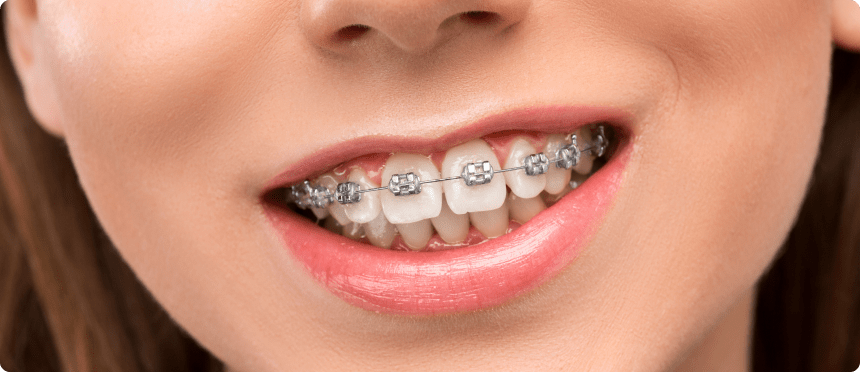 Orthodontics in Alicante at Dental Family Bushin