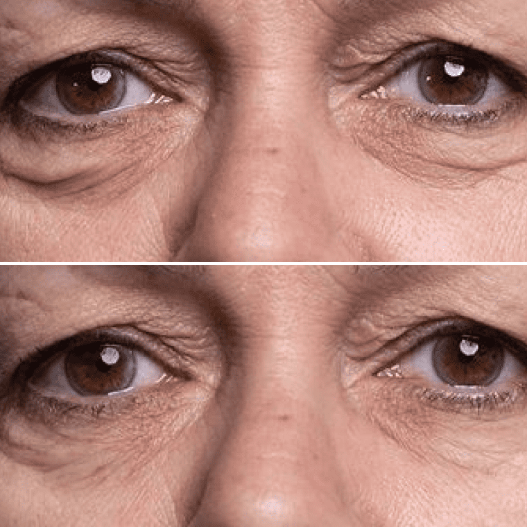 до та після — Анна, 39
