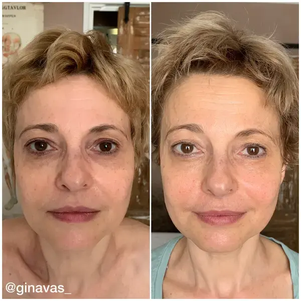 Before and after — Sculptural Face Lifting
