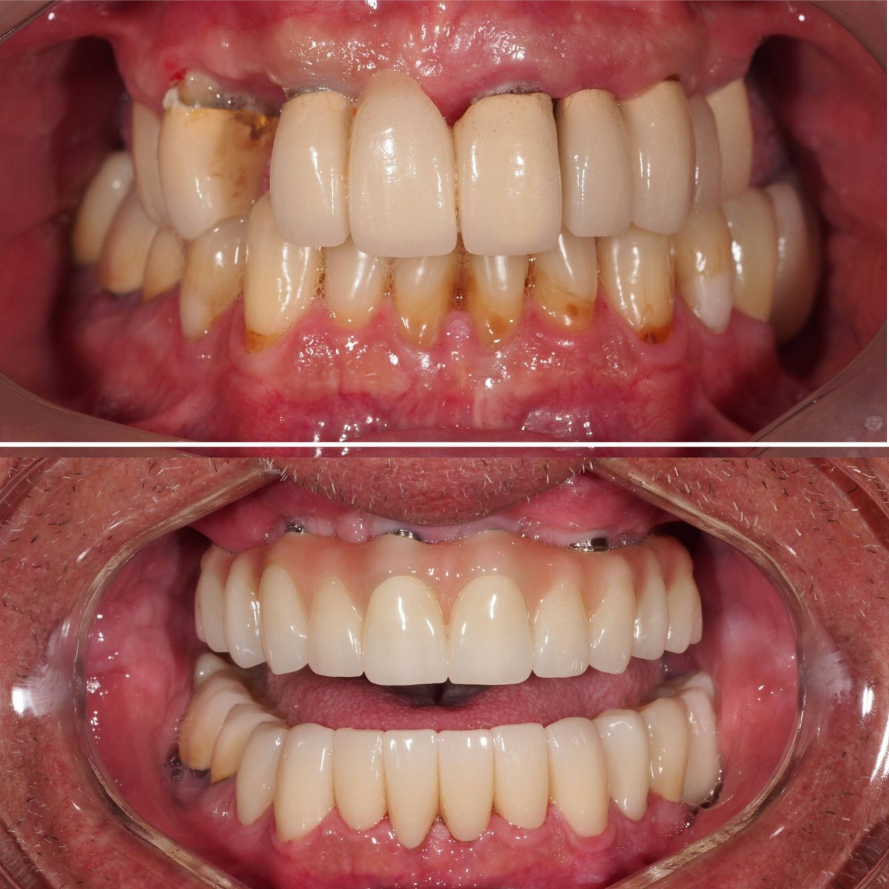 Healthy dental implant crown restoration