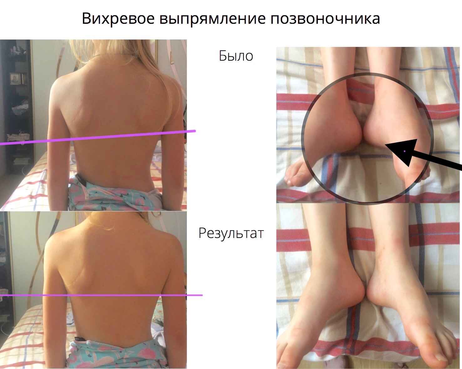 Вихревое выпрямление позвоночника, детский сколиоз