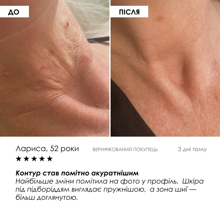 До та після: Лариса, 52 роки — відгук покупниці