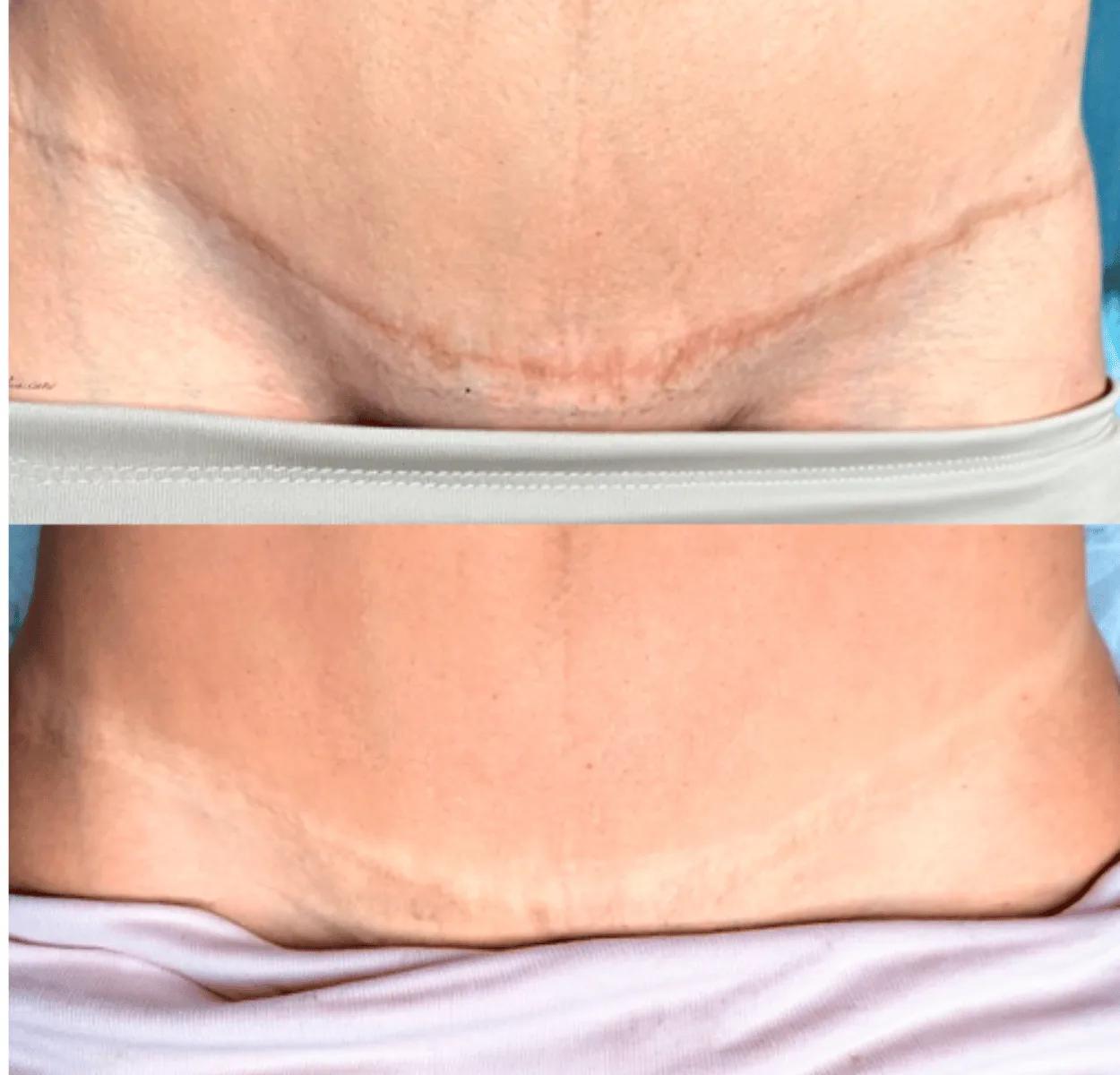 Cicatrice horizontale d’abdominoplastie sur le bas-ventre, avant et après dermopigmentation réparatrice : la ligne blanche se rapproche de la teinte de la peau.