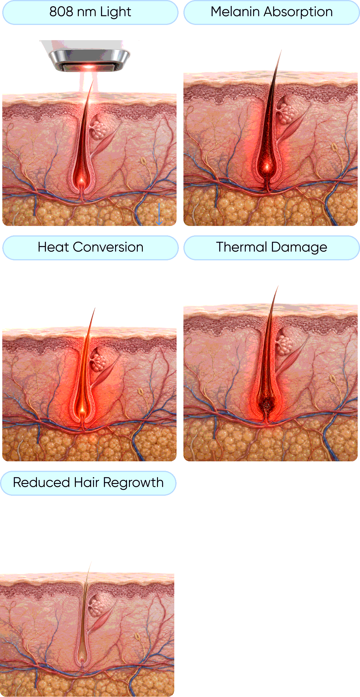 Laser hair reduction: 808 nm light, melanin absorption, heat conversion, thermal damage, reduced hair regrowth