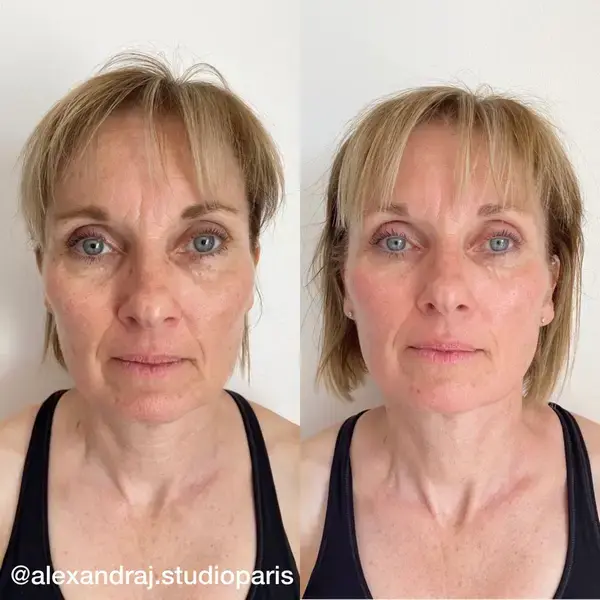 Before and after — Sculptural Face Lifting
