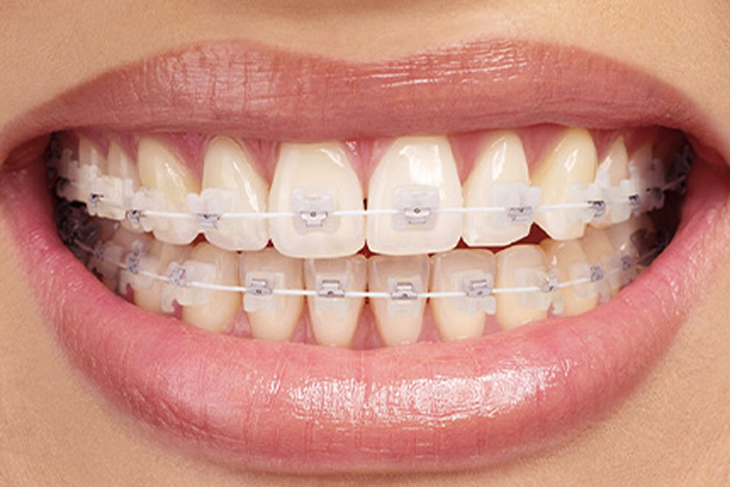 Prim-plan: aparat dentar cu brackets ceramici
