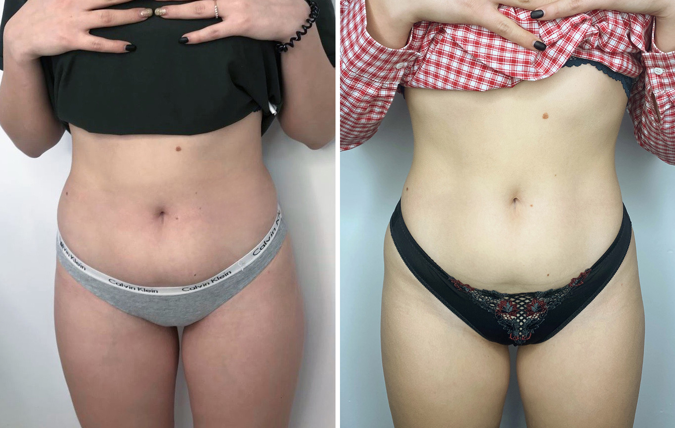 До и после процедурное фото_Zemits Bionexis