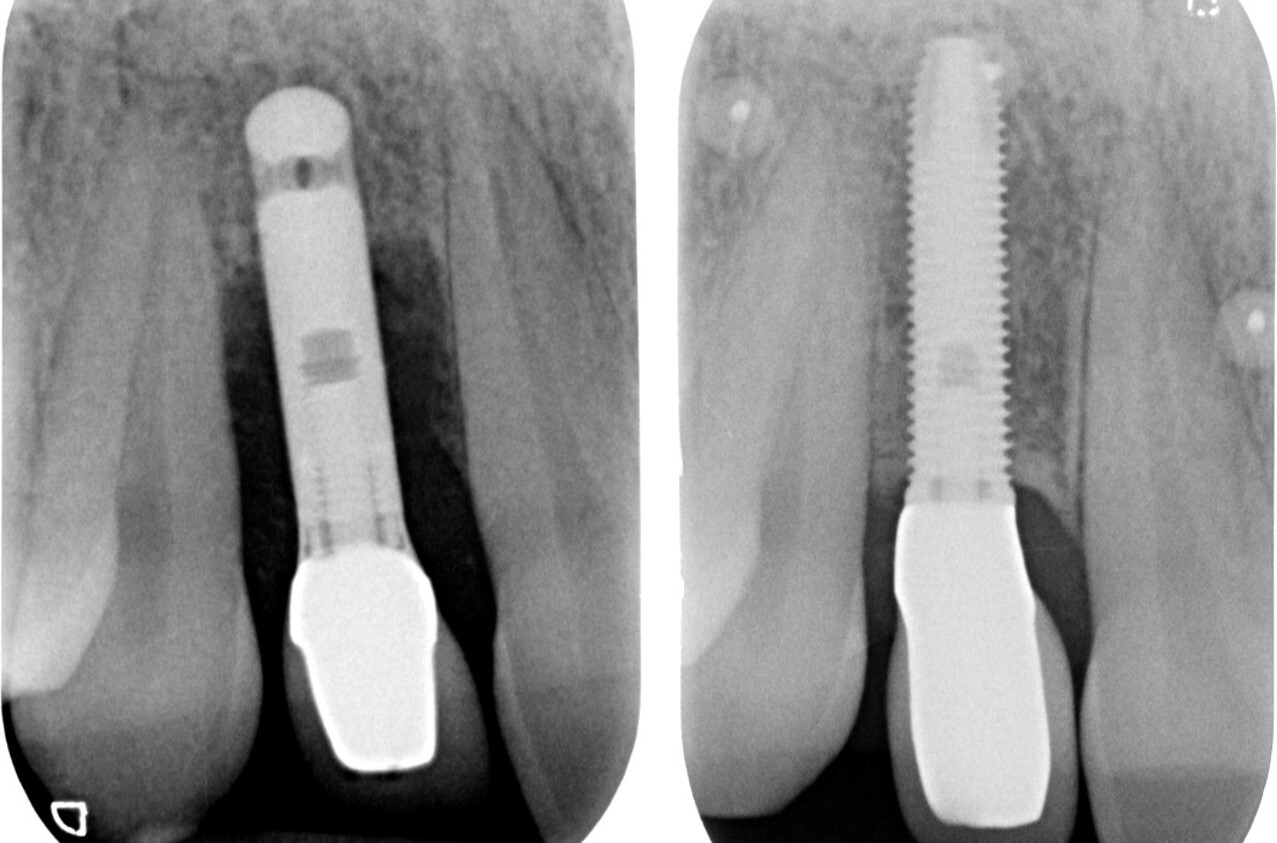 Przypadek kliniczny — kontrola RTG implantu