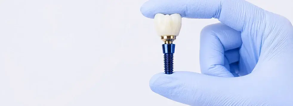 Multiple Teeth Implants