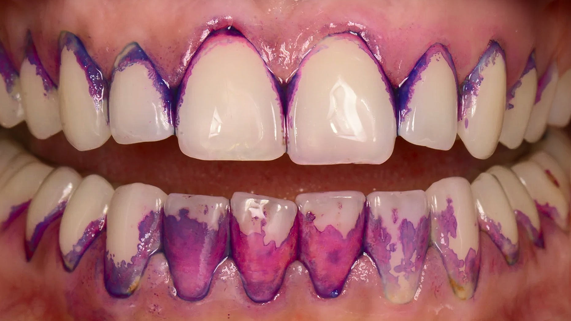 Teeth before GBT treatment