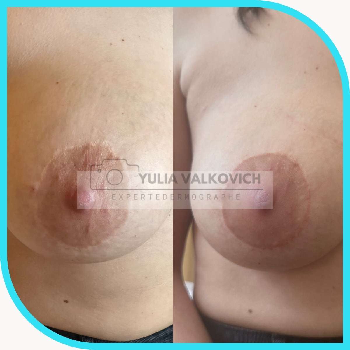 Aréole irrégulière et décolorée après chirurgie mammaire, avant et après dermopigmentation réparatrice : couleur homogène et contour régulier.