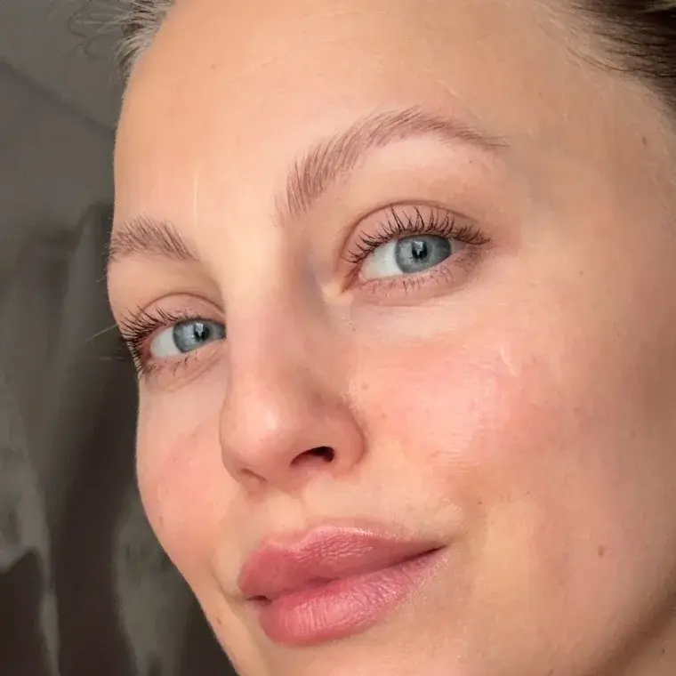 Fałda między brwiami