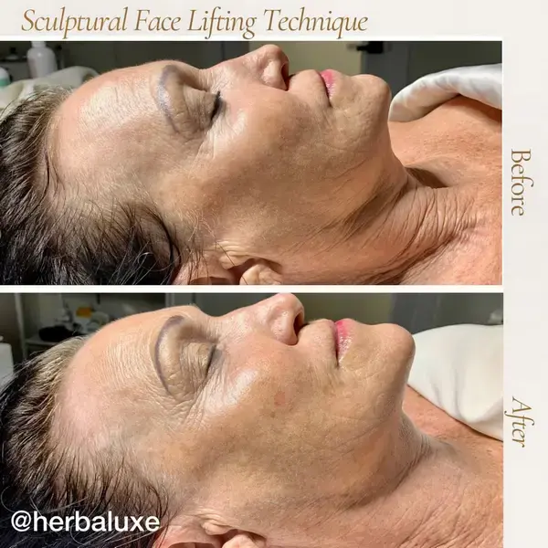 Before and after — Sculptural Face Lifting
