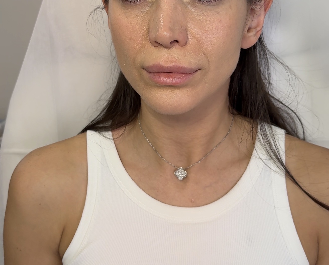 Cheek Enhancement Before