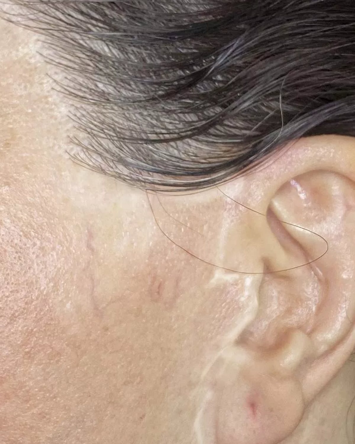 Cicatrice de lifting devant l'oreille, avant dermopigmentation