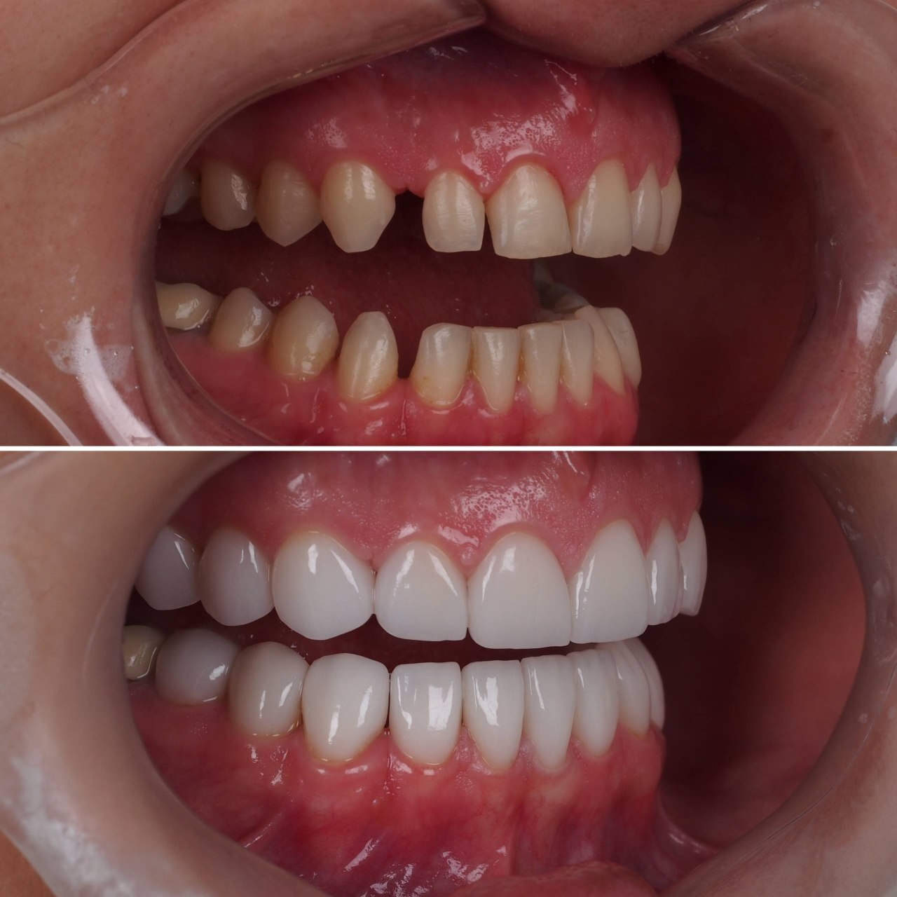 Dental implant procedure close up teeth