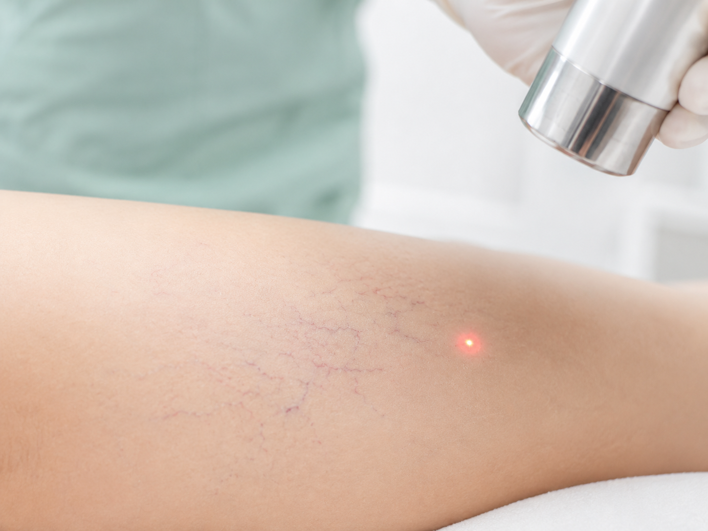 Kriolazer Kriosklero (CLaCs) müalicəsi